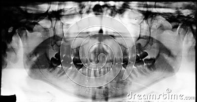 Full mouth dental xray (x-ray) Stock Photo