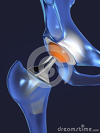 Function of a hip joint implant or hip prosthesis in frontal view Cartoon Illustration