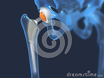 Function of a hip joint implant or hip prosthesis in frontal view Cartoon Illustration