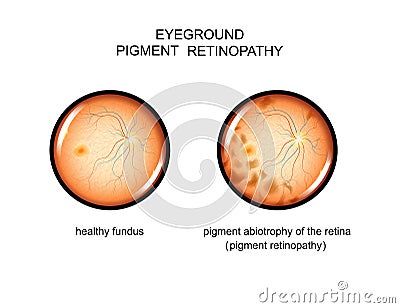 Fundus. pigment retinopathy Vector Illustration