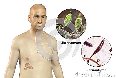 Fungal infection on a man's body. Tinea corporis, 3D illustration Cartoon Illustration