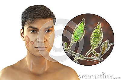 Fungal infection on a man's face, 3D illustration. Tinea faciei, caused by fungi Microsporum canis, Trichophyton rubrum, T. Cartoon Illustration