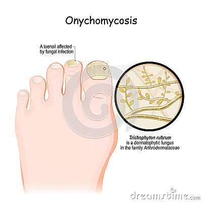 Fungal infection of the nail. close-up of A toenail affected by dermatophytic fungus Vector Illustration