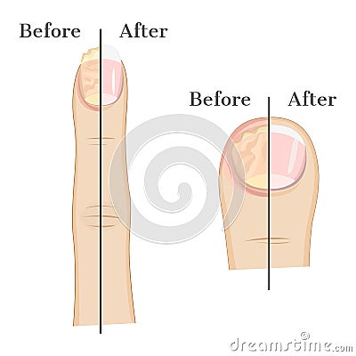 Fungal infection of the nail Vector Illustration