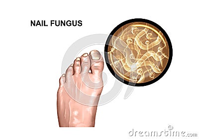 Fungal lesion of the foot Stock Photo