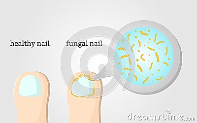 Fungal nail infection and healthy nail disease or beauty problem on the toe vector Vector Illustration