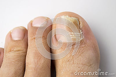 Fungal nail infection Stock Photo
