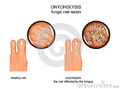 Fungal nail lesion Vector Illustration