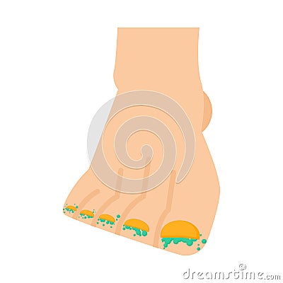 Fungus on legs. Nail disease. Toe infection. vector illustration Vector Illustration