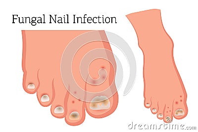 Fungus on nails, diseases of the skin of the feet Vector Illustration