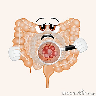 Illustration of bowel cancer Cartoon Illustration