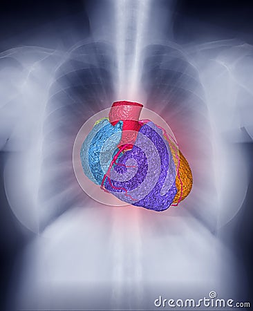 Fusion image of Chest X-ray image and 3D CTA Coronary artery Image showing heart inside the chest . Stock Photo
