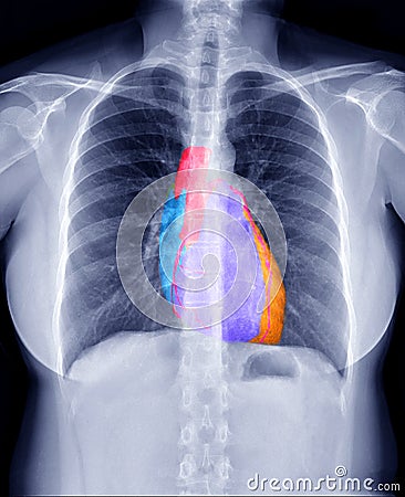 Fusion image of Chest X-ray image and 3D CTA Coronary artery Image showing heart inside the chest. Stock Photo