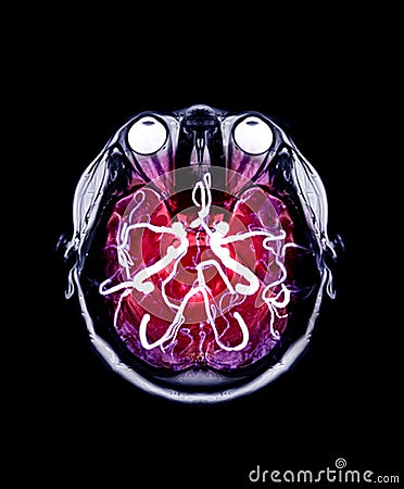 Fusion image of MRI brain and MRA Brain. Stock Photo