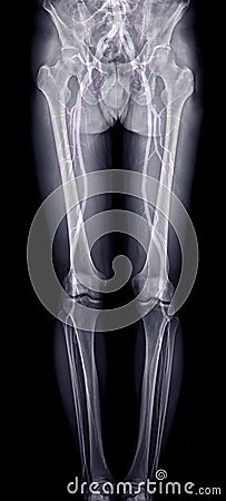 Fusion image scanogram of lower limb and CTA Femoral run off . Stock Photo