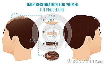 FUT hair loss treatment Cartoon Illustration