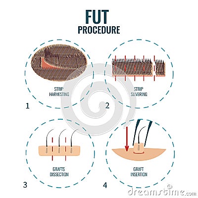 FUT hair loss treatment Vector Illustration