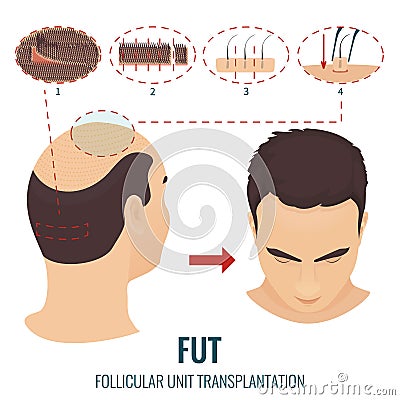 FUT hair loss treatment Vector Illustration
