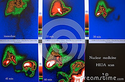 Gallbladder ejection fraction nuclear scan Stock Photo