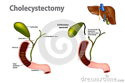 Gallbladder Removal Surgery. Laparoscopic cholecystectomy. Vector Illustration