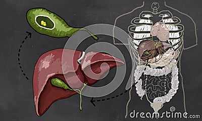 Gallbladder Stone Illustration on Blackboard Stock Photo