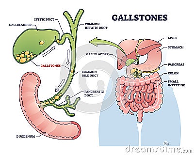 Gallstones as stones of cholesterol in gallbladder organ outline diagram Vector Illustration