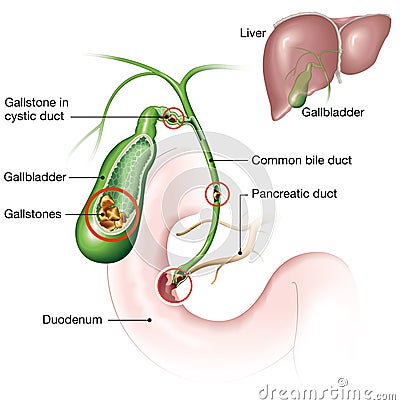 Gallstones in gallbladder, anatomical 3D illustration Cartoon Illustration