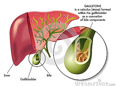 Gallstones Vector Illustration