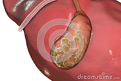 Gallstones, illustration showing bottom view of liver and gallbladder with stones Cartoon Illustration