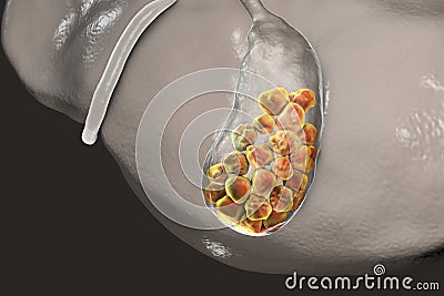 Gallstones, illustration showing bottom view of liver and gallbladder with stones Cartoon Illustration