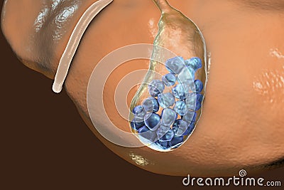 Gallstones, illustration showing bottom view of liver and gallbladder with stones Cartoon Illustration