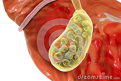 Gallstones, illustration showing bottom view of liver and gallbladder with stones Cartoon Illustration