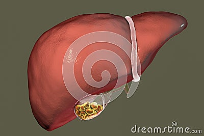 Gallstones, illustration showing front view of liver and gallbladder with stones Cartoon Illustration