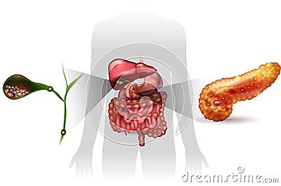 Gallstones, pancreatitis Vector Illustration