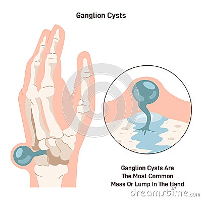 Ganglion cyst. Fluid-filled lump under the skin of a wrist or hand. Synovial Vector Illustration