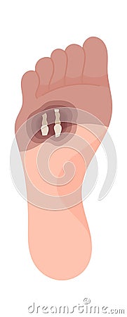 Gangrene Forefoot Disease Vector Illustration