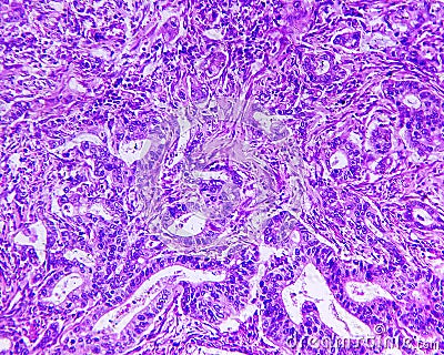 Gastric adenocarcinoma of a human Stock Photo