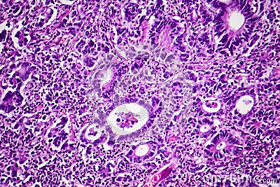 Gastric adenocarcinoma, light micrograph Stock Photo