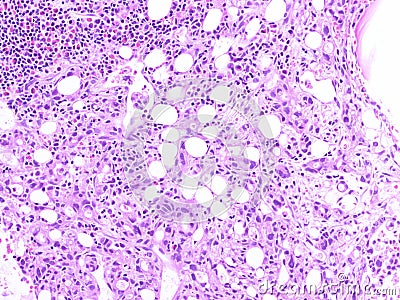 Gastric adenocarcinoma in bone marrow. Stock Photo