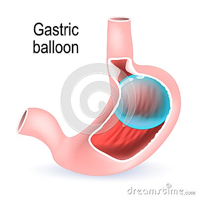 Gastric balloon. inflatable medical device for reduce weight. Vector Illustration