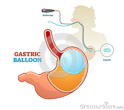 Gastric balloon medical procedure concept diagram, vector illustration. Weight loss and obesity treatment. Vector Illustration