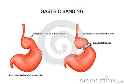 Gastric band, stretched from overeating Vector Illustration