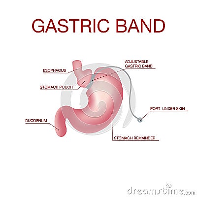 Gastric Band Weight Loss Surgery.Band with a Port that Under the Skin Vector Illustration