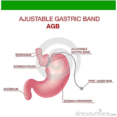 Gastric Band Weight Loss Surgery.Band with a Port that Under the Skin Vector Illustration