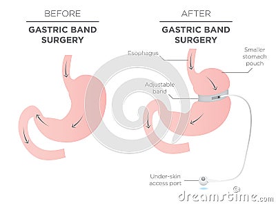 Gastric Band Weight Loss Surgery Vector Illustration