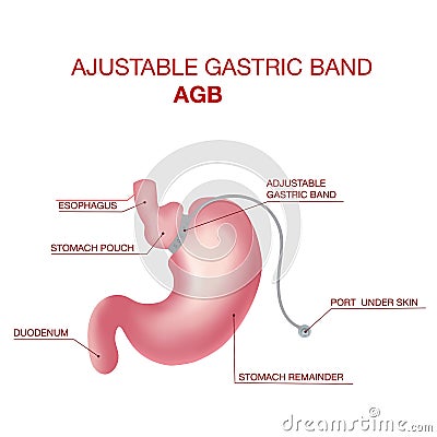 Gastric Band Weight Loss Surgery.Band with a Port that Under the Skin Vector Illustration