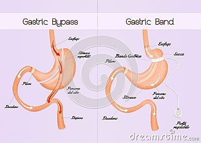 Gastric bypass and gastric band Stock Photo