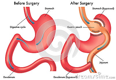 Gastric bypass Vector Illustration