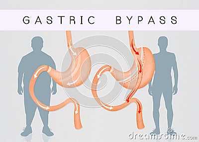 Before and after gastric bypass surgery Stock Photo