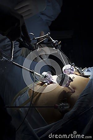 Gastric bypass surgery Stock Photo